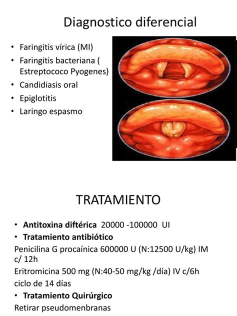 difteria pdf